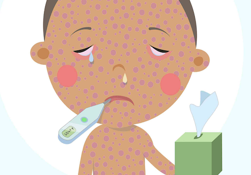 WisContext: Why Wisconsin presents a ‘perfect opportunity’ for a measles outbreak